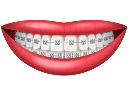 Dental clip in Coimbatore for teeth alignment correction