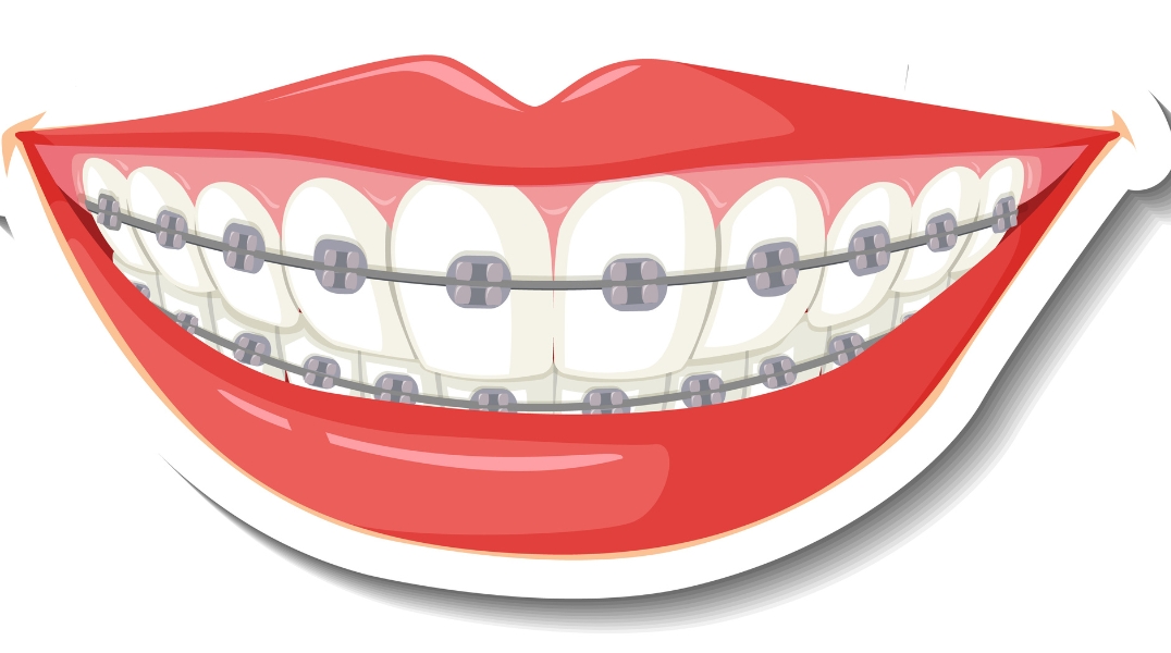 Teeth clip treatment in Coimbatore at UniqDentalClinic