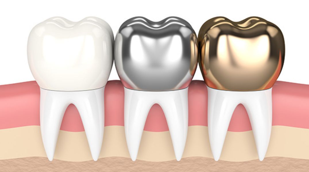 Dental Crown Cost in Coimbatore, Dental Crown in Coimbatore, Dental Crown Treatment Cost in Coimbatore
