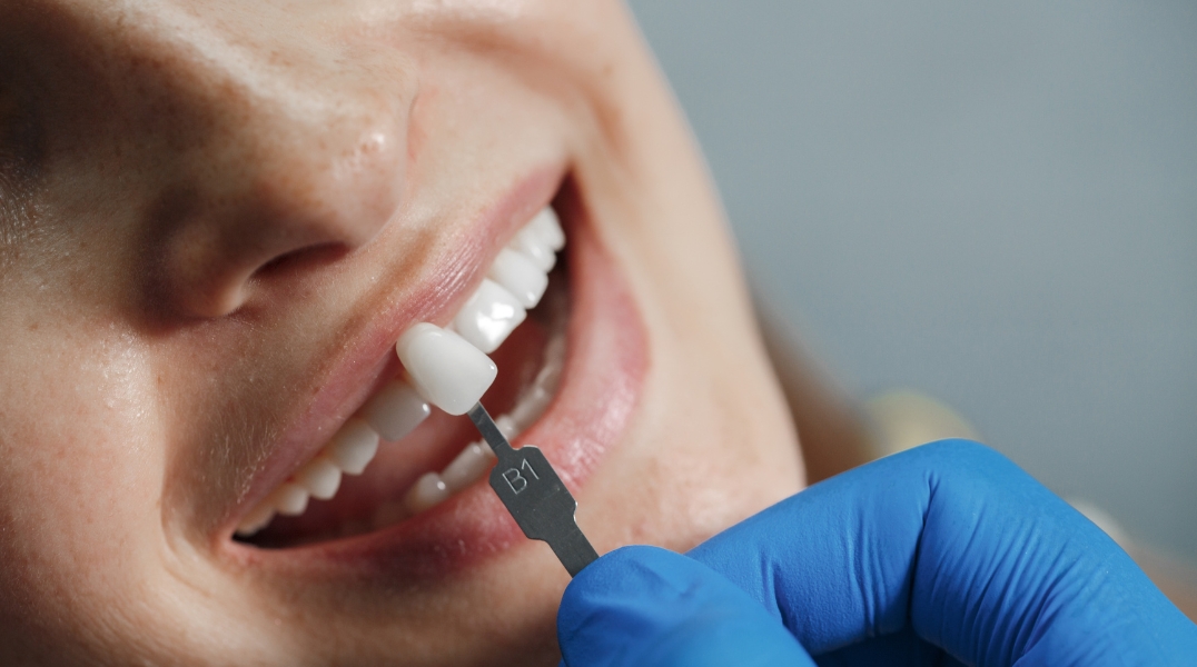 Teeth reshaping treatment in Coimbatore for smooth and perfectly contoured teeth