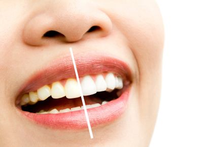 Professional teeth whitening treatment in Coimbatore at Uniq Dental Clinic