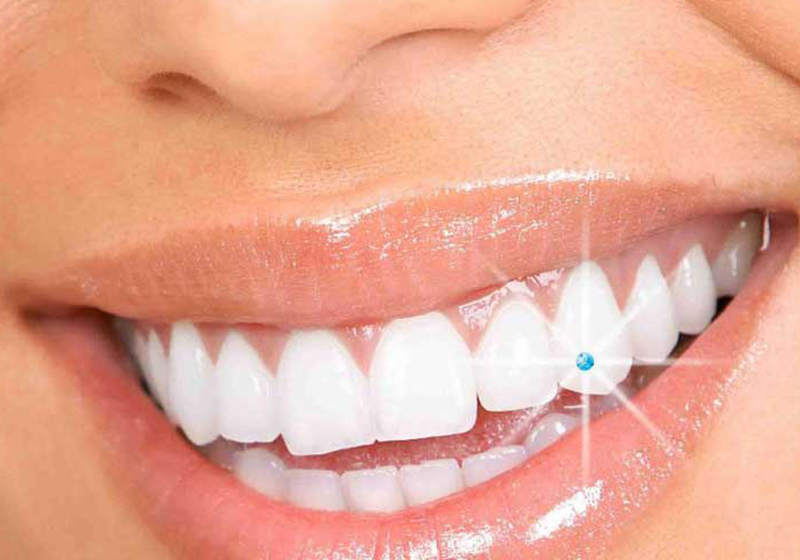 Dental Jewellery in Coimbatore