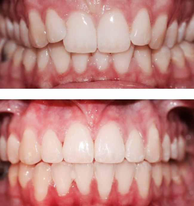 Full correction before and after Invisalign case, Coimbatore