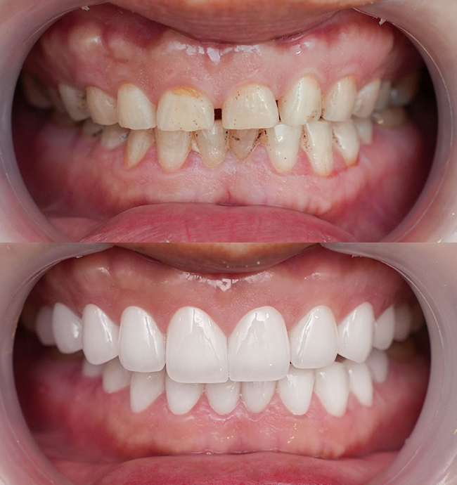 Protrusion before and after Invisalign case, Coimbatore