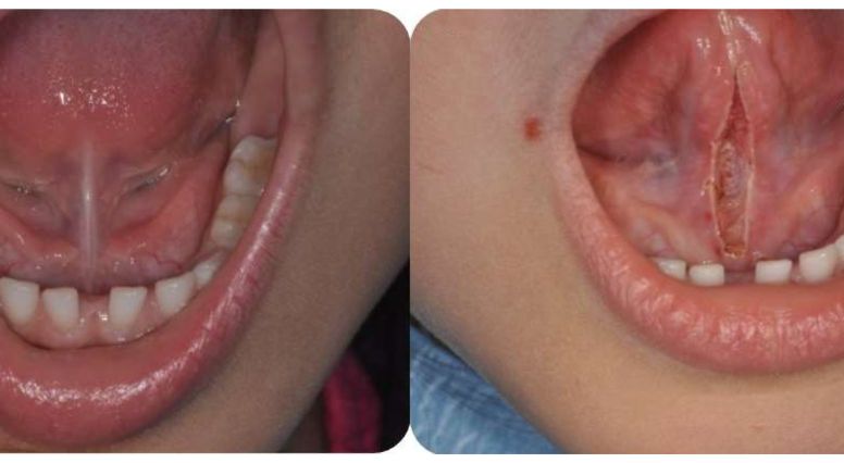 Tongue Tie Release in Coimbatore | Frenectomy Release in Coimbatore
